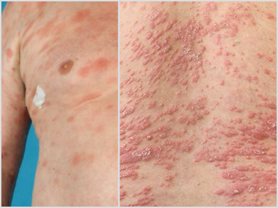 MF vs Psoriasis