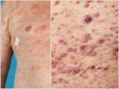MF vs Pityriasis Lichenoides