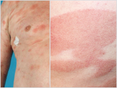 MF vs Eczema